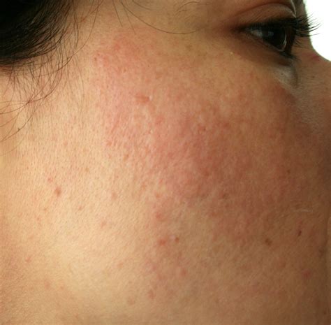 We did not find results for: i have a rash on face. The dermatologist told me to take lupus
