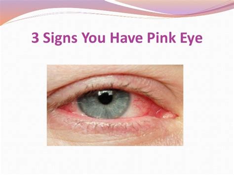 Pink Eye Symptoms Baby