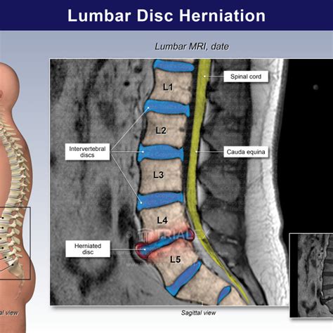 Lumbar Disc Herniation Trialexhibits Inc