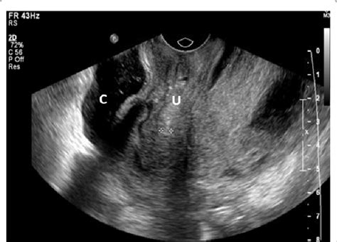 Transvaginal Ultrasound Sagittal Image Showing Retro Uterine Mass