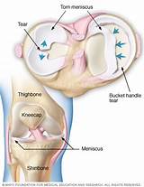 Images of Meniscus Rehabilitation