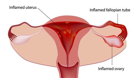 7 Reasons For Painful Periods And Menstrual Cramps Everyday Health