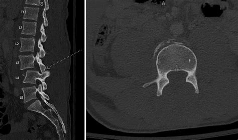 Traumatic Bilateral L3 4 Facet Dislocation With Open Decompression And