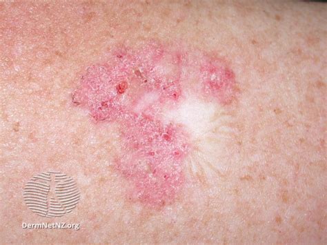 Filesuperficial Basal Cell Carcinoma Trunk Dermnet Nz 3 Sup Bcc