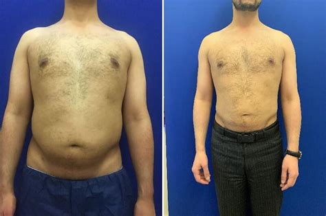 Before And After Male Liposuction Results Neinstein Plastic Surgery