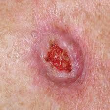 Molluscum contagiosum skin infection molluscum is known as an infected skin disorder by the virus. Dermatology RPA Flashcards - Cram.com