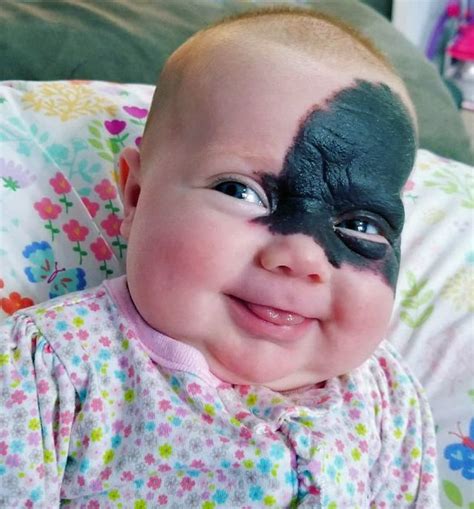 Baby Born With Huge Batman Mask Birthmark On Her Face Big World Tale