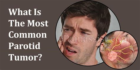 What Is The Most Common Parotid Tumor And How Do You Know If You Have It