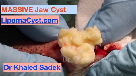 MASSIVE Jaw Cyst Dr Khaled Sadek LipomaCyst Com YouTube