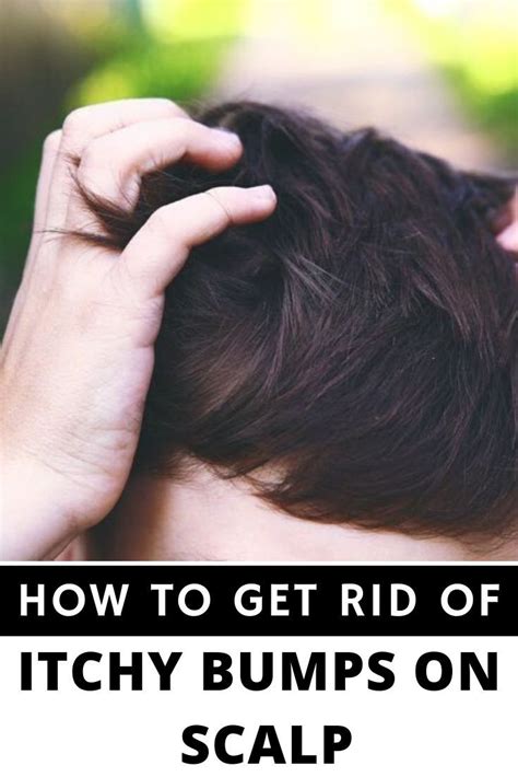 Lie bumps, or transient lingual papillitis, are small bumps that appear. How To Get Rid Of Itchy Bumps On Scalp in 2020 | Itchy ...