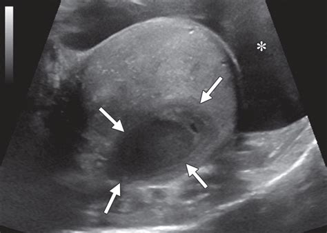 Imaging Of Penile And Scrotal Emergencies Radiographics Sexiz Pix