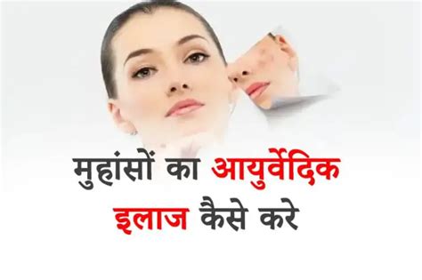 18 Best Ayurvedic Treatment For Pimples In Hindi मुहांसों के लिए