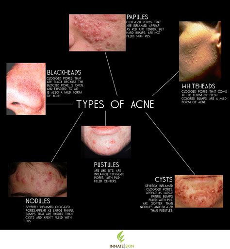 what acne types you re dealing with if you re serious about treating it as soon as possible