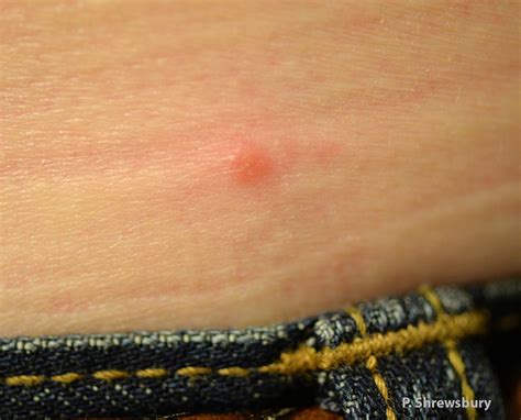 Check spelling or type a new query. Time for ticks: Lone star tick, Amblyomma americanum , Blacklegged ticks, Ixodes spp., and ...