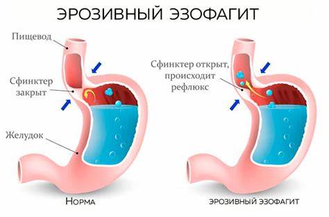 Эзофагит лечение диета симптомы Эзофагит с рефлюксом: лечение, симптомы, причины Эзофагит с рефлюксом: лечение, симптомы, причины Эзофагит лечение диета симптомы