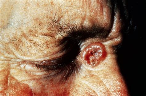 Basal Cell Carcinoma Eyelid Rodent Ulcer