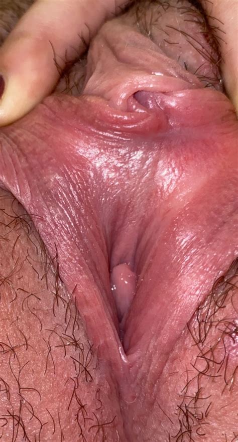 Can Anyone Advise If This Is Lichen Sclerosus Planus Or Genital