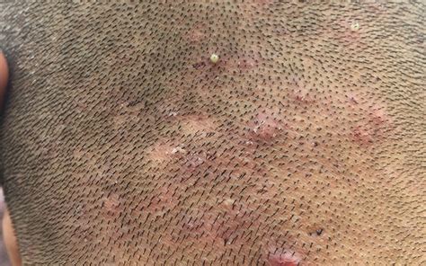 Scalp Acne Types Causes Treatments And Prevention Vedix