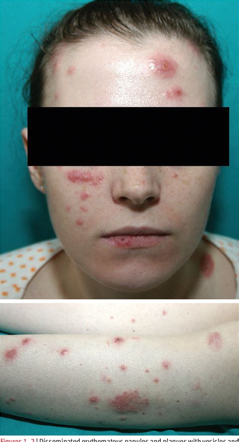 Figure 1 From Acute Febrile Neutrophilic Dermatosis In A Patient With