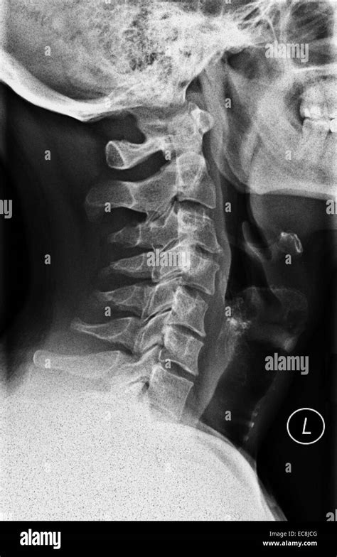 Normal Neck X Ray Hi Res Stock Photography And Images Alamy