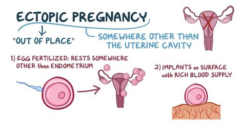 Ectopic Pregnancy Pathophysiology Diagram My XXX Hot Girl