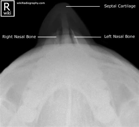 Nasal Bones Radiographic Anatomy Wikiradiography