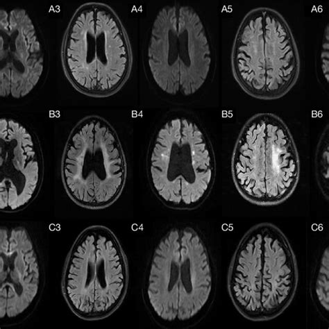 Brain Mri Findings Of Three Patients With Alsp The First And Second