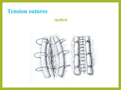 Basic Suture Patterns Sutures Basic Veterinary Surgery