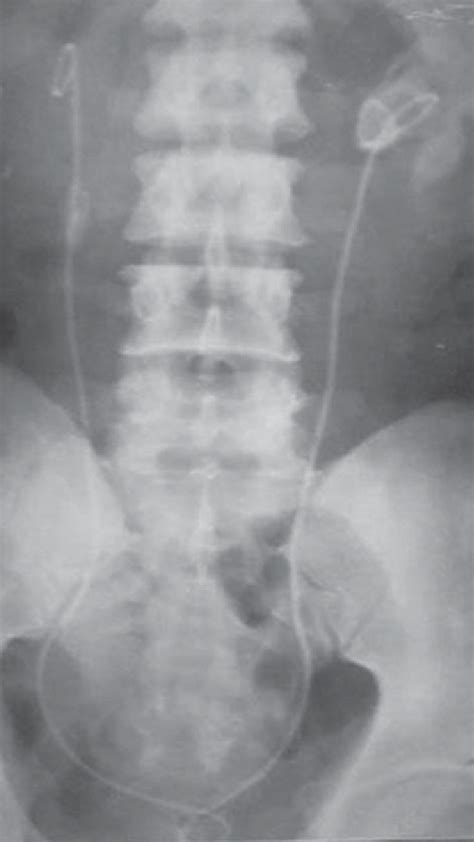 Plain Film Radiography Of A Patient Who Presented With Renal Failure
