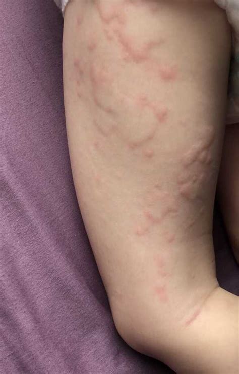 3 Year Old Keeps Getting An Allergic Reaction — Digital Spy