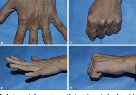 Direct Repair Of The Sagittal Band For Extensor Tendon Subluxation