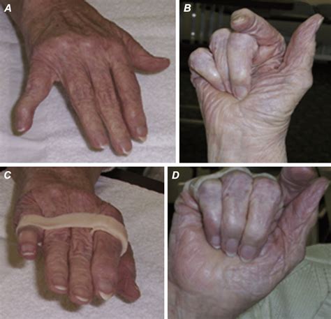 A And B Rheumatoid Arthritis With Metacarpophalangeal Joint