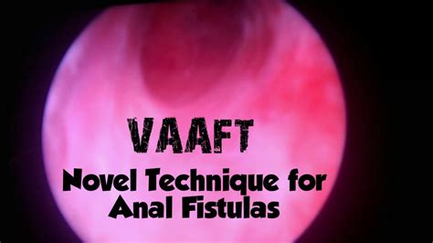Vaaft Novel Technique For Anal Fistulas Draravind Ps Surgical