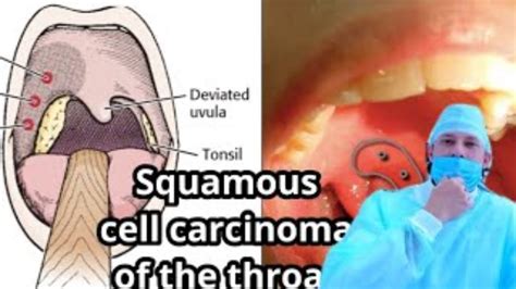 Squamous Cell Carcinoma Of The Throat Squamous Cell Carcinoma Of The