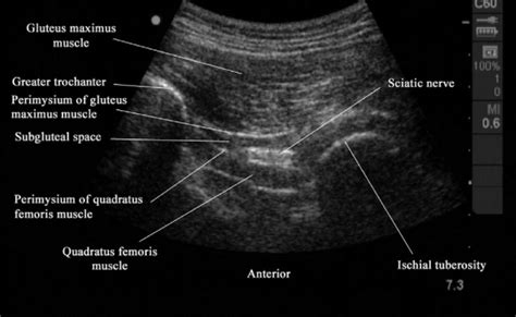 Ultrasound Guided Transgluteal Sciatic Nerve Block For Gluteal Otosection