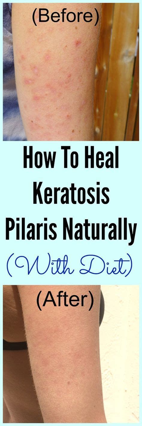 How To Heal Keratosis Pilaris Kp Naturally With Diet Natural