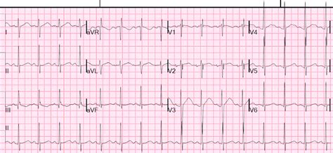 Dr Smiths Ecg Blog Chest Pain And Convex St Elevation In Precordial