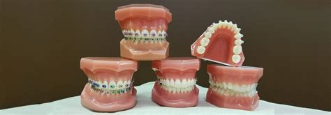 Traditional Metal Clear Braces Arvada CO Thornton CO
