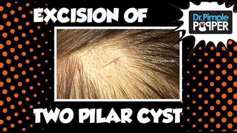 Two Great Pilar Cysts Excised By Dr Rebish Youtube