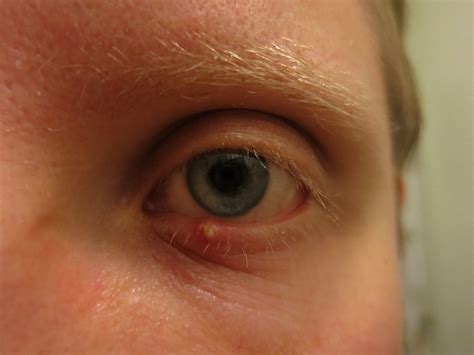 Stye Under Eyelid Causes Symptoms Treatments Fastmed Urgent Care