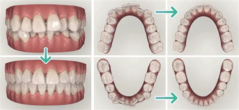 Cosmetic Dentistry With Invisalign Sydney Holistic Dental Centre