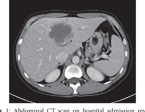 Figure 1 From Hepatic Abscess In A Returning Traveler With Crohns