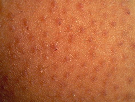 Skin Bumps Keratosis