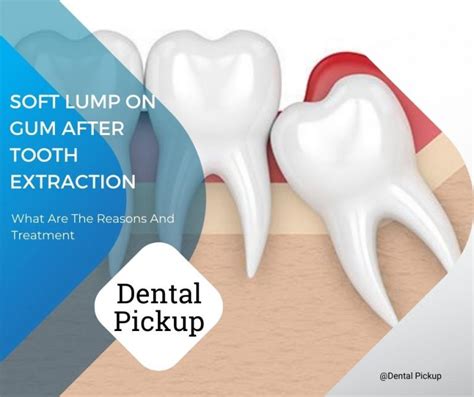 Soft Lump On Gum After Tooth Extraction What Are The Reasons