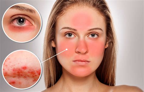 About Redness And Burning Of Skin Causes Redness And What To Do