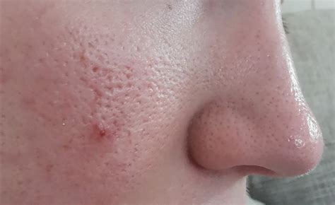 Severely Enlarged Pores General Acne Discussion Forum