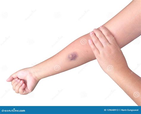 Bruises From Blood Collection Isolated On White Background Royalty