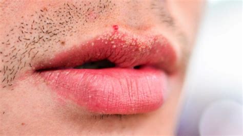 bumps on lips small little white or red causes and treatment american celiac