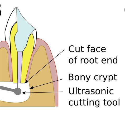 Schematic Representation Of A Cross Section Of A Single Rooted Tooth