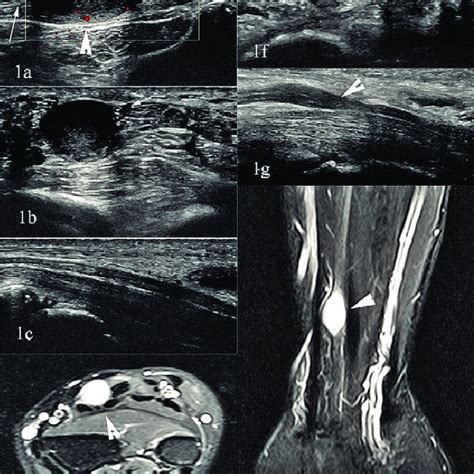 Anterior Approach To Posterior Interosseous Nerve Decompression